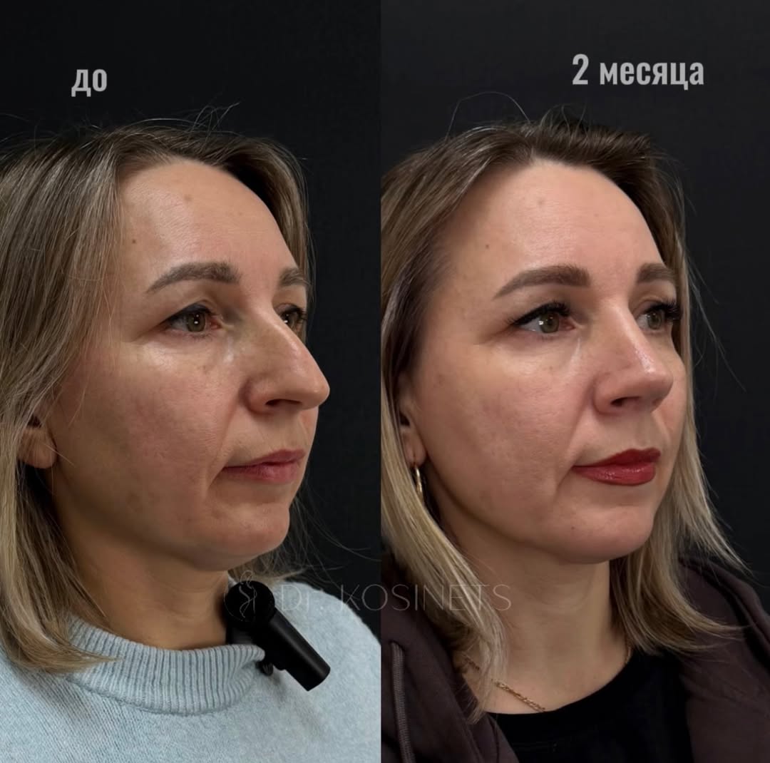 риносептопластика