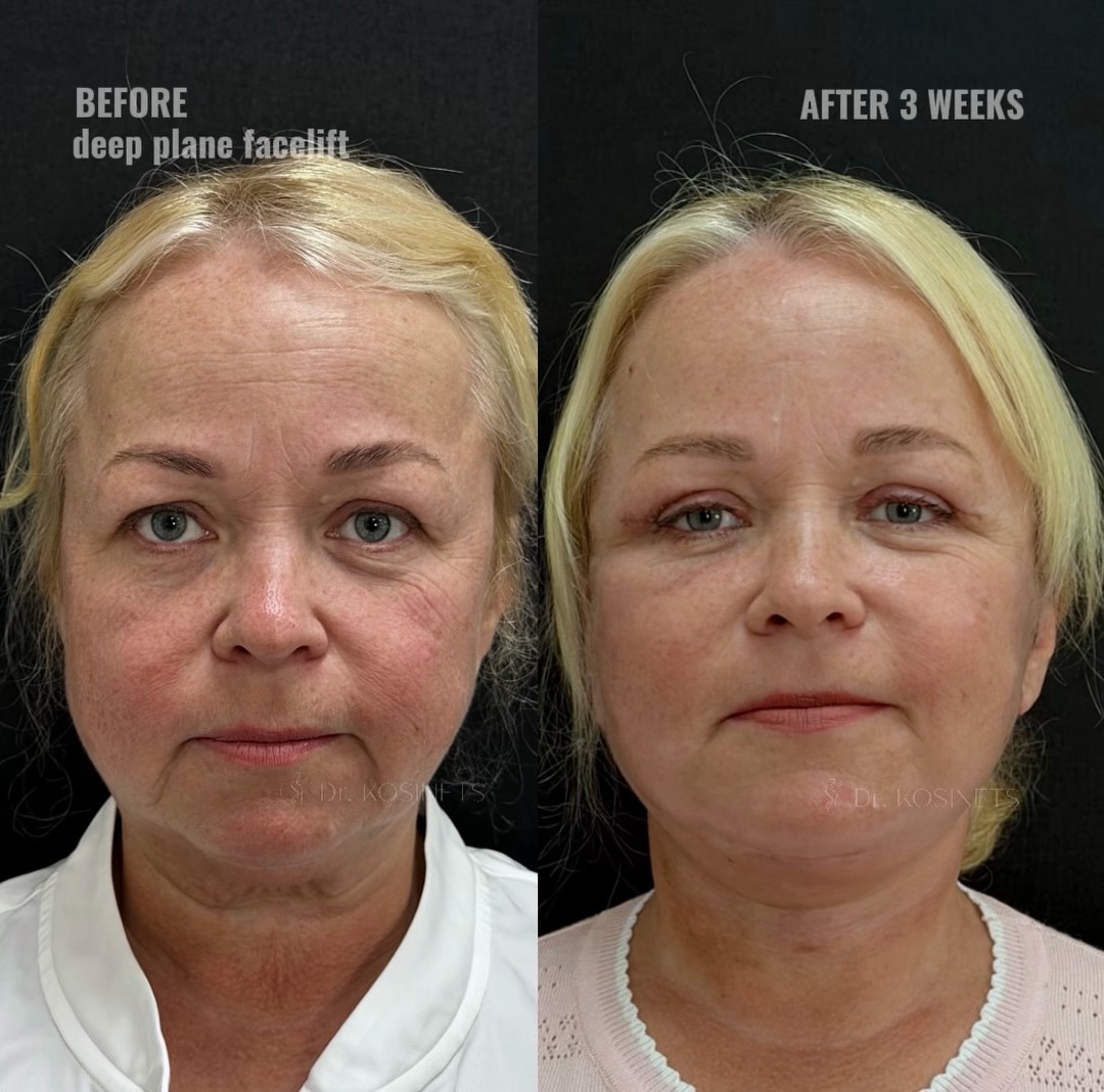 deepplanefacelift