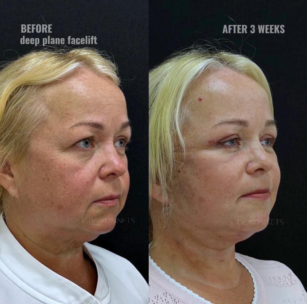 deepplanefacelift