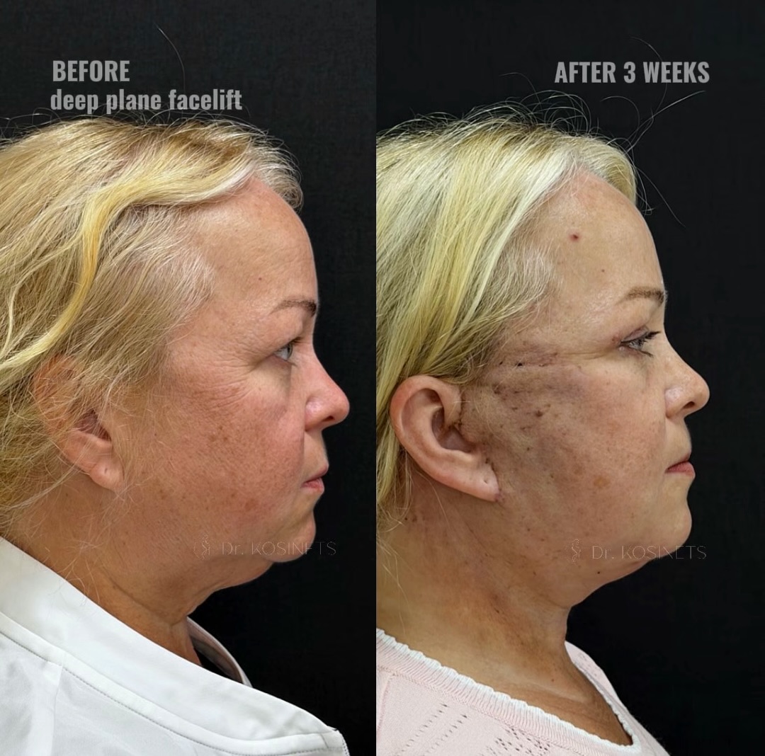 deepplanefacelift