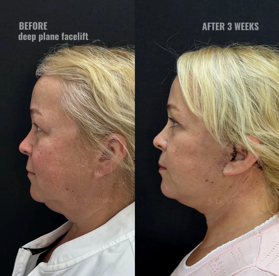deepplanefacelift