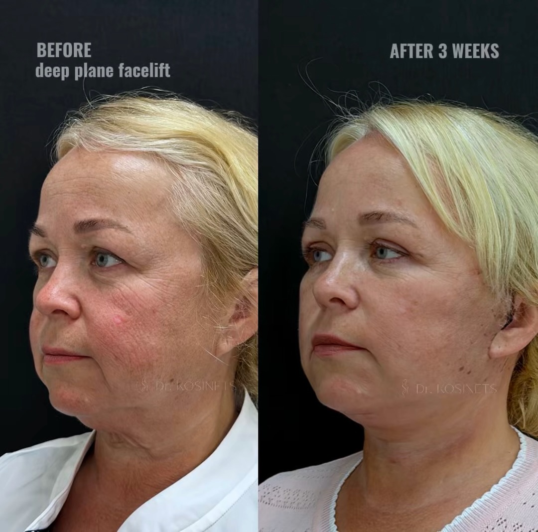 deepplanefacelift