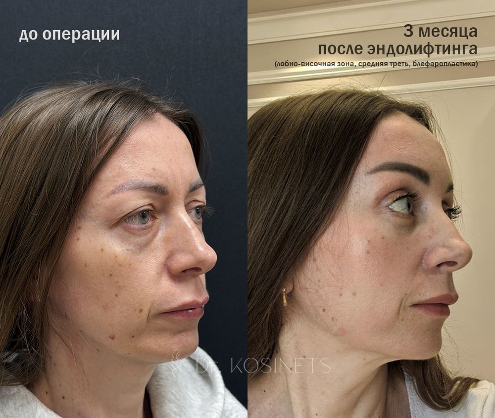 эндолифтинг
