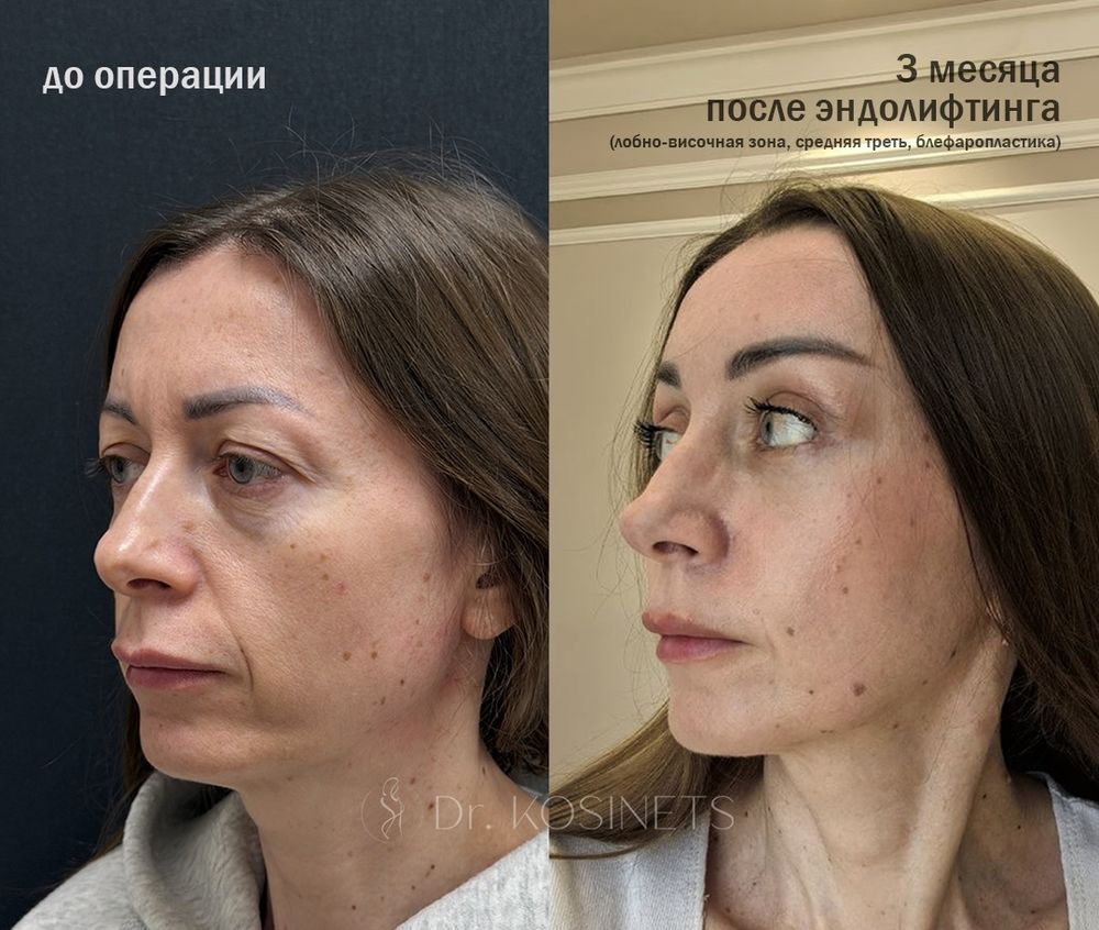 эндолифтинг