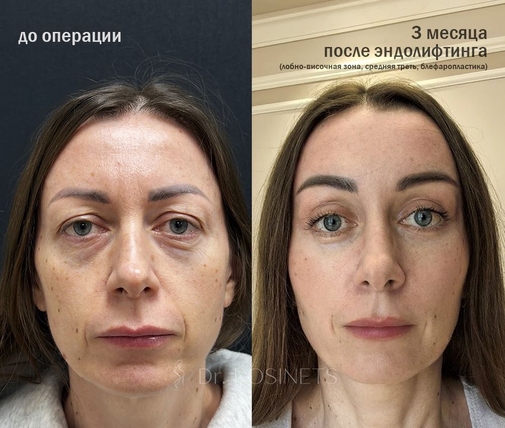 эндолифтинг
