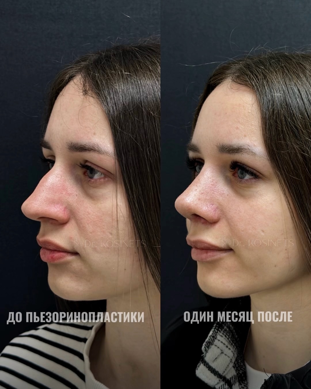 пластика горбинки носа