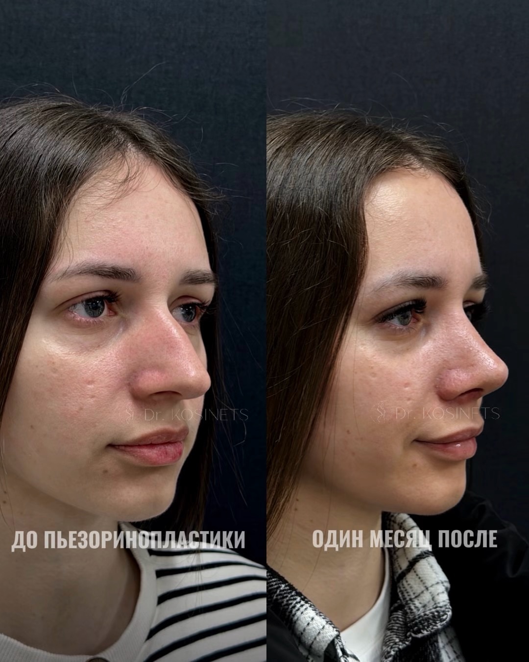 пластика горбинки носа