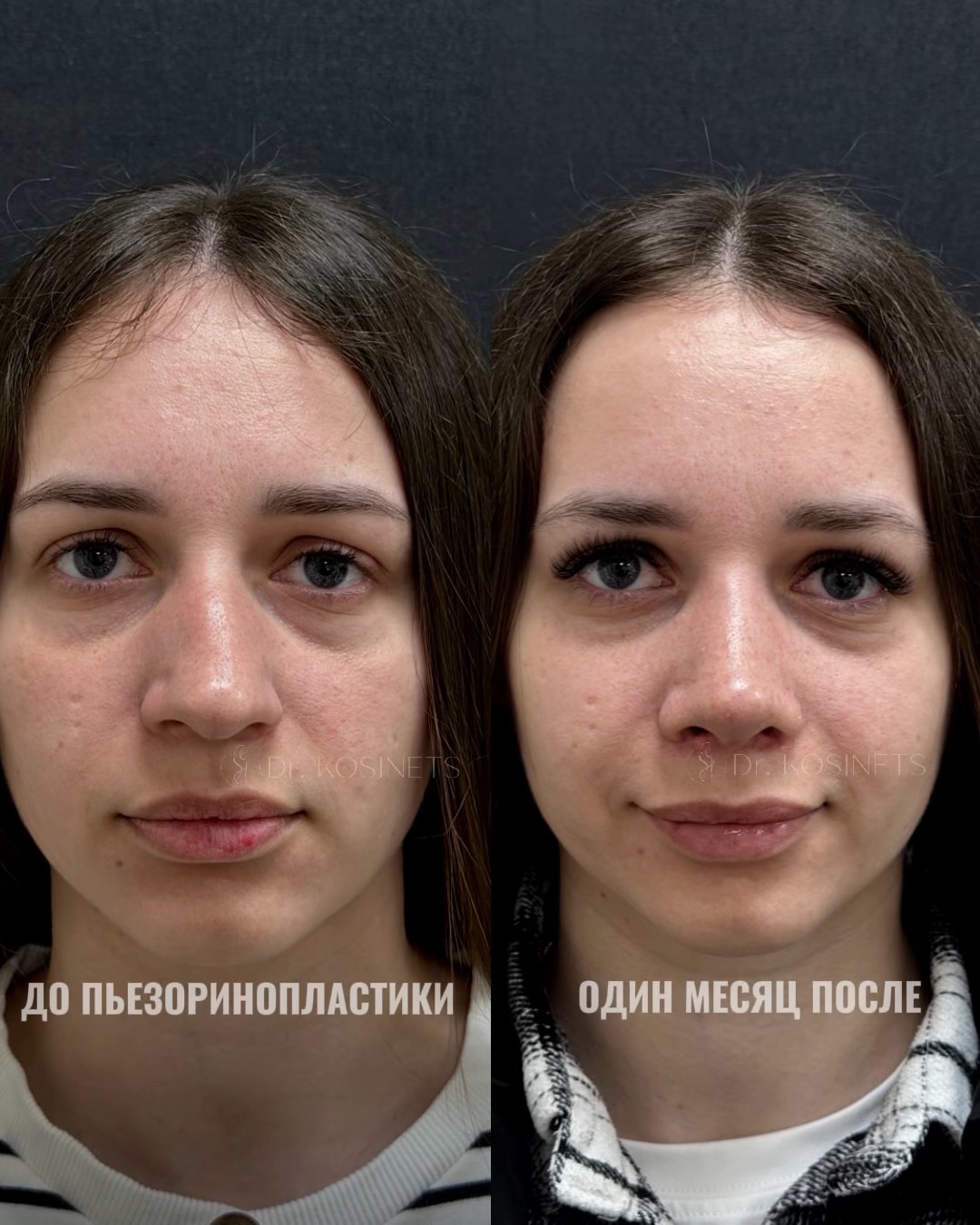пластика горбинки носа