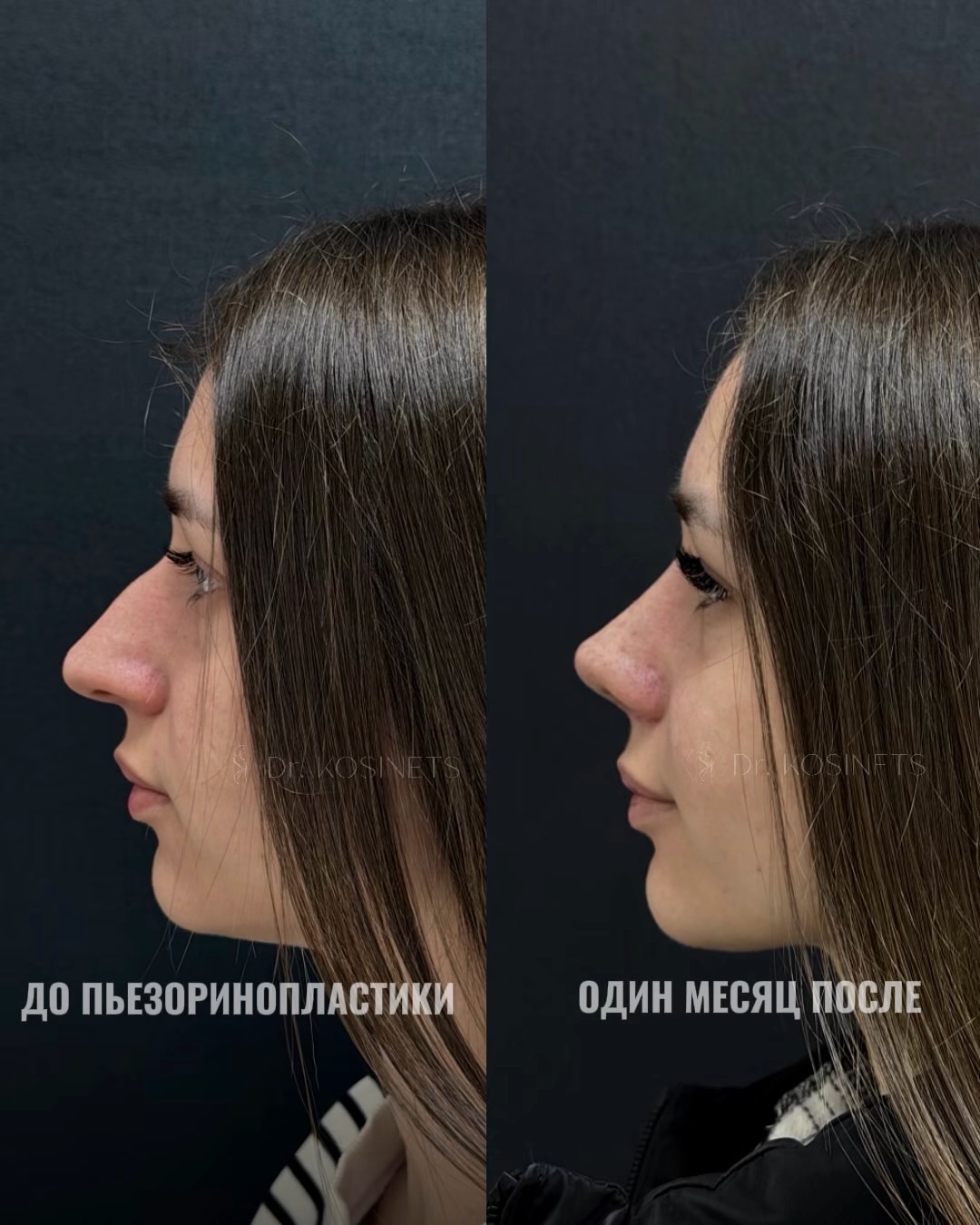 пластика горбинки носа