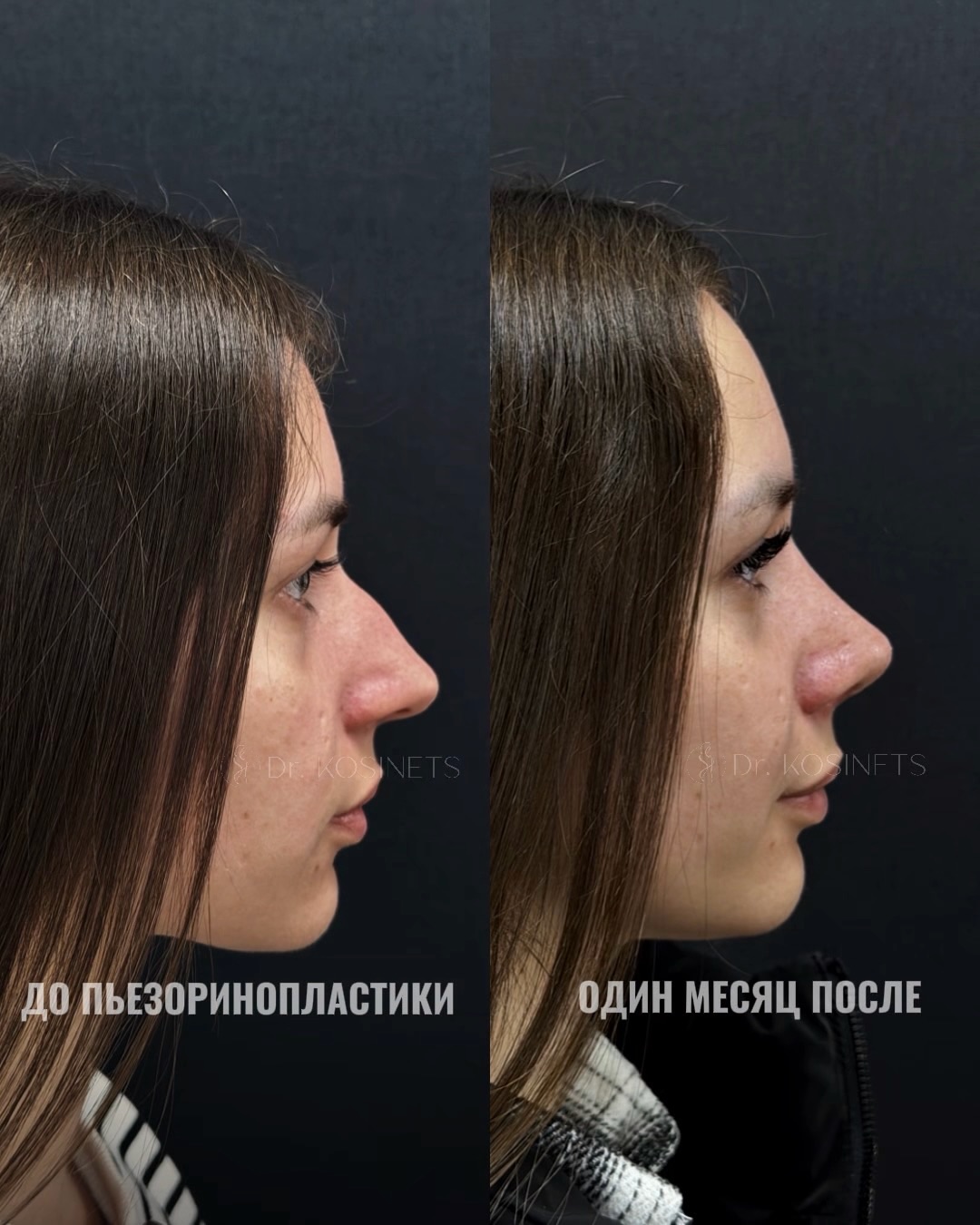 пластика горбинки носа
