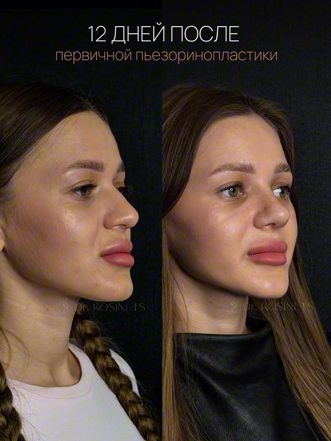 ринопластика носа