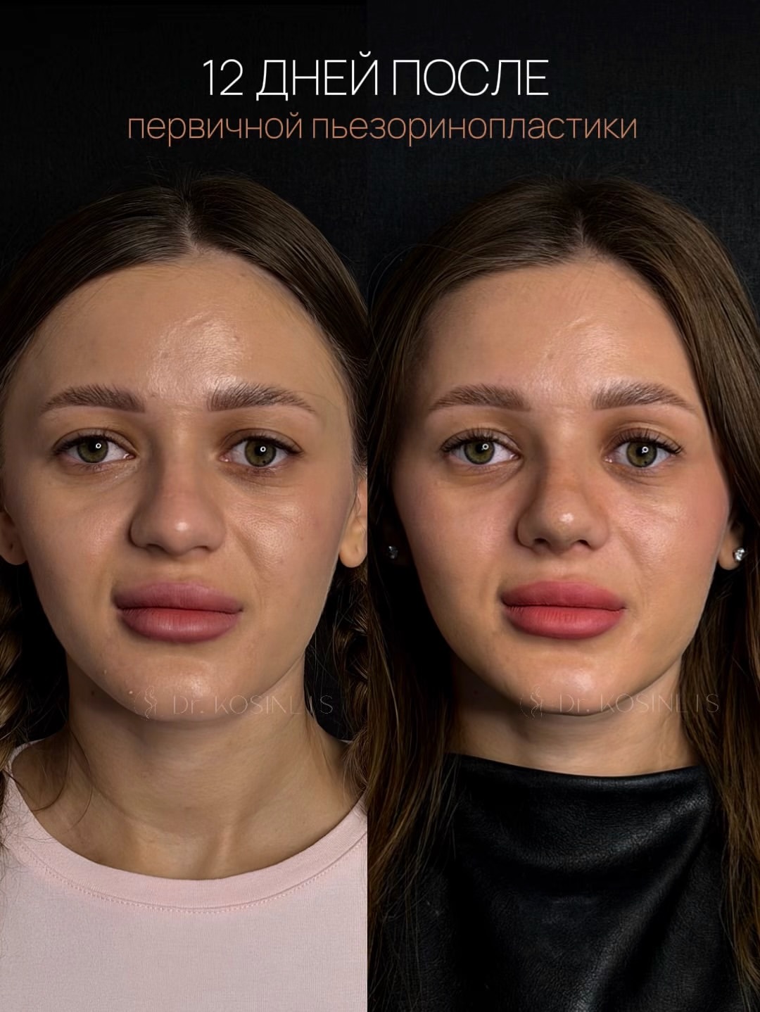 ринопластика носа