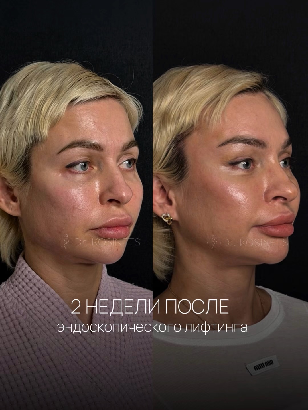 фейслифтинг