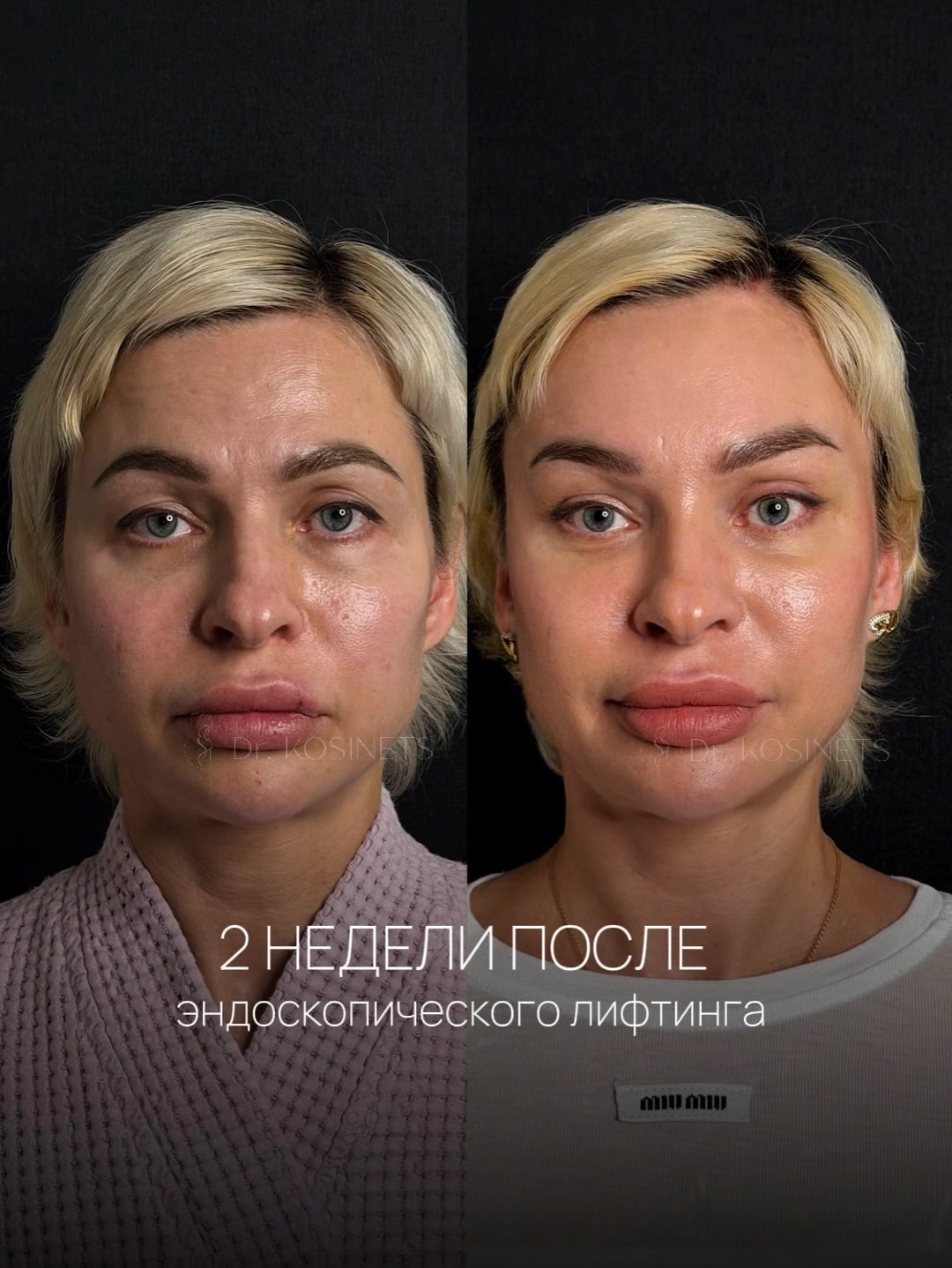 фейслифтинг