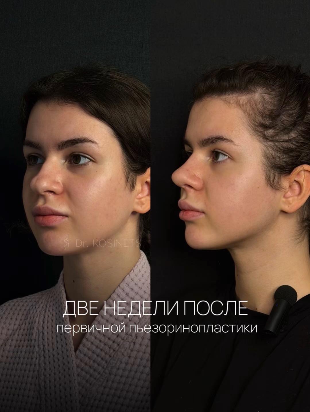 Rhinoplasty