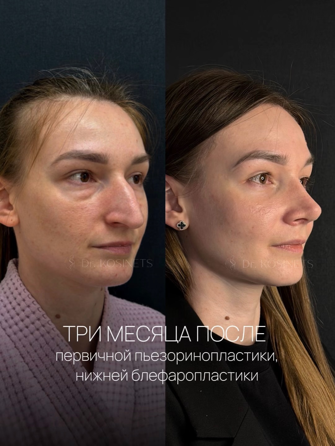 пьезоринопластика