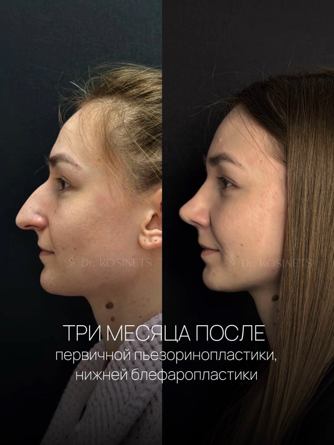 пьезоринопластика