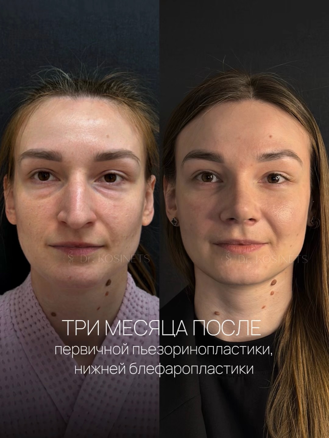 пьезоринопластика